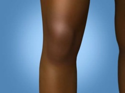 osteonecrose do joelho