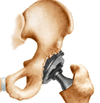 artropastia da anca