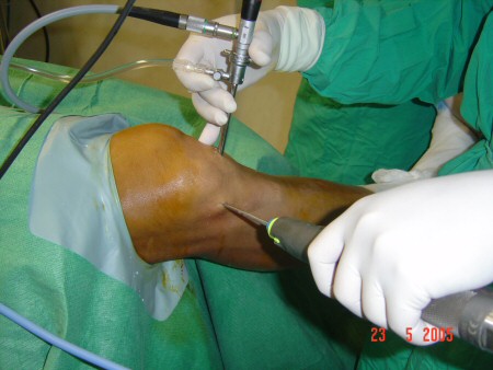 condroplastia artroscópica do joelho